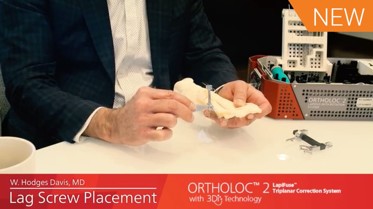 ORTHOLOC™ 2 LapiFuse™ Lag Screw Placement [AP013483A] VLC