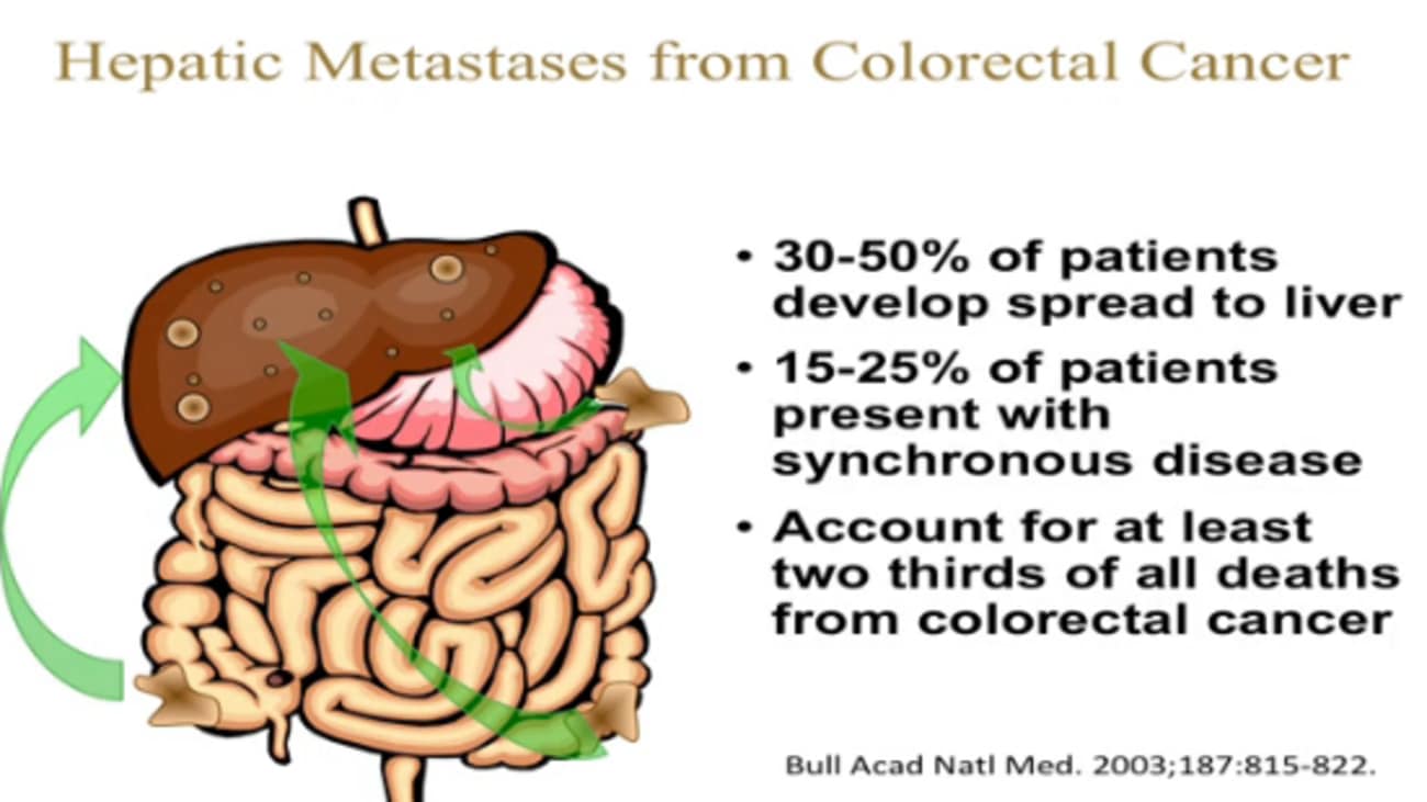 Colorectal Liver Metastases With Extrahepatic Disease Surgical Outcomes Perry Shen Md 5147