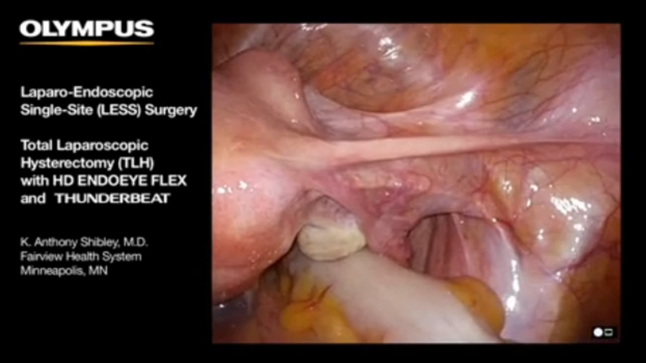 Single Site Total Laparoscopic Hysterectomy With Triport Endoeye Flex