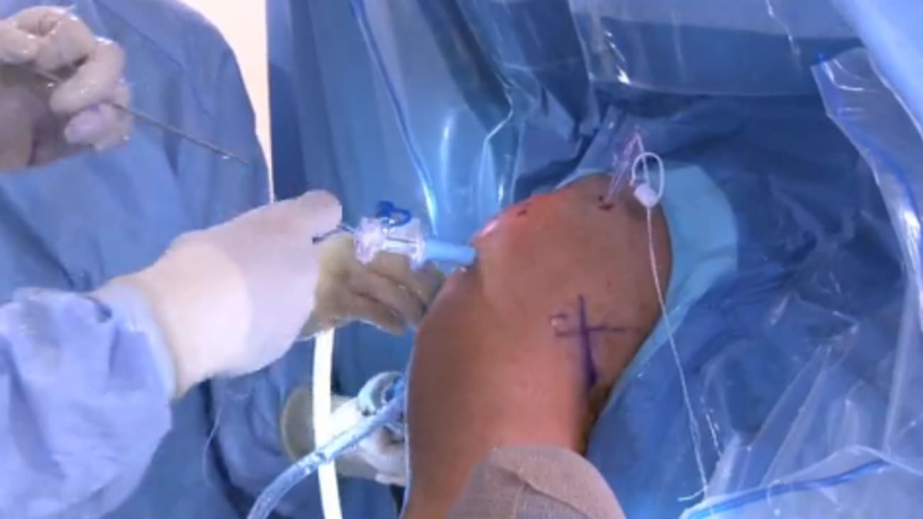 Shoulder rotator cheap cuff treatment