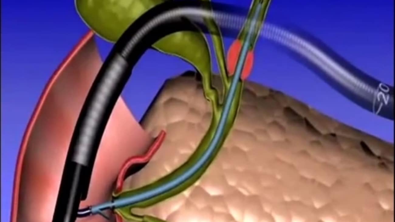 Procedural Animation Advanix™ Biliary Stent with NaviFlex™ RX Delivery