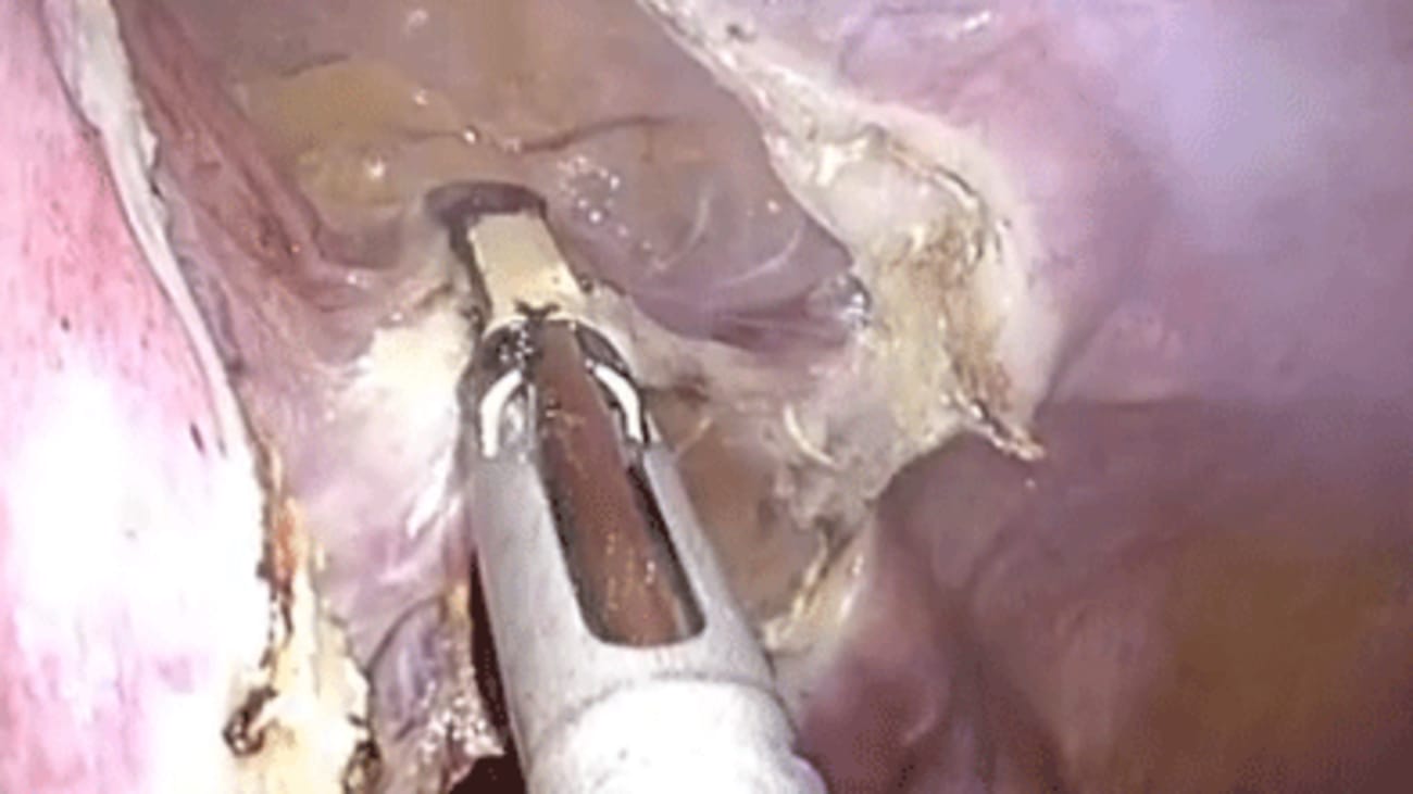Single Site Laparoscopic Supracervical Hysterectomy Lsh Broadcastmed