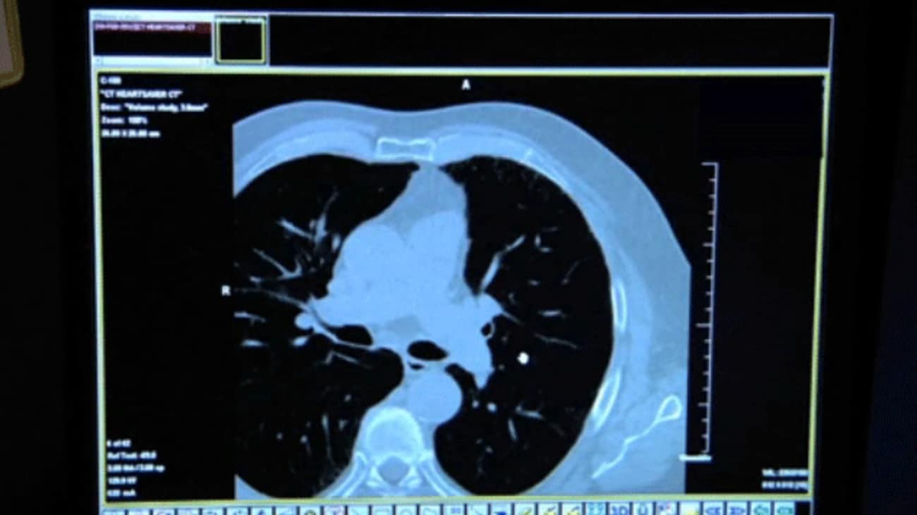 does a ct scan of the heart show blockages
