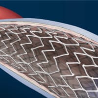 Optimize Venous Stenting Outcomes