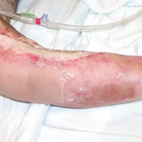 Burns 102: Escharotomy for 3rd Degree (Full-Thickness) Burns