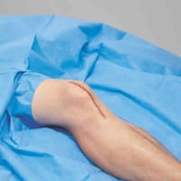 Infection Prevention & Management in Joint Replacements