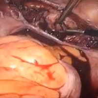 Total Laparoscopic Hysterectomy with PKS Omni