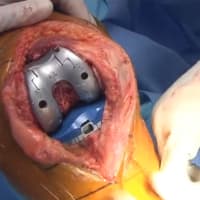 JOURNEY™ II Cruciate Retaining (CR) Knee System Surgery