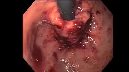 Mount Sinai Introduces Two Novel Endoscopy Procedures