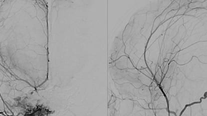 Infantile Dural Sinus Malformation Curative Embolization in Two Stages With Scepter Mini Balloon Microcatheter