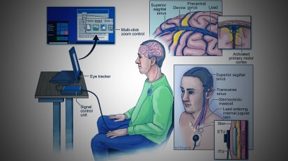 Mount Sinai Receives $2.9 Million To Study First-of-Its-Kind Brain Implant for Restoring Function in Paralyzed Patients