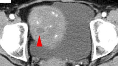 Johns Hopkins Researchers Advance Role of Circulating Tumor DNA to Detect Early Melanoma Growth, Uncover Treatment Options