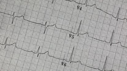 New Studies: AI Captures Electrocardiogram Patterns That Could Signal a Future Sudden Cardiac Arrest