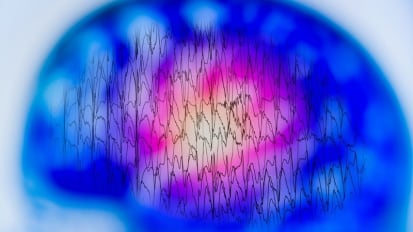 Investigational Drug for People with Treatment-Resistant Epilepsy