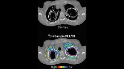 New Tool for an Old Disease: Use of PET and CT Scans May Help Develop Shorter TB Treatment