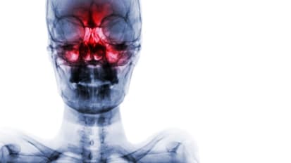 Muscle Gene Mutations Implicated in Human Nasal/Sinus Cancer