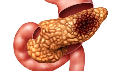 New Study Will Test If ‘Inoperable’ Pancreatic Tumors Can Be Safely Removed