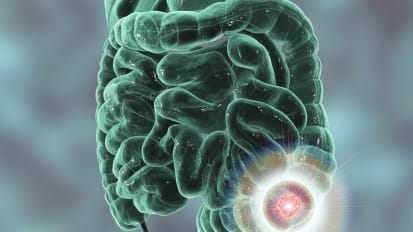 Survival Similar for Younger and Older Patients with Metastatic Colorectal Cancer, Study Finds