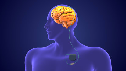 Case Study: Asleep Deep Brain Stimulation Brings Relief to Patients with Movement Disorders