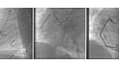 Johns Hopkins Experts Lead Development of New AHA/ACC Guideline on Coronary Revascularization