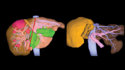 Johns Hopkins Surgeons Pioneer Combination of Procedures for Patients with Advanced Colorectal Cancer