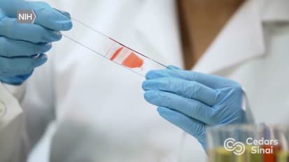 Can a Blood Test Detect Alzheimer’s Disease?