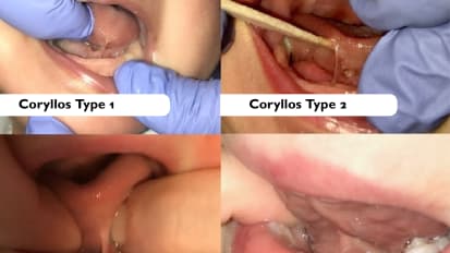 Better Understanding Ankyloglossia