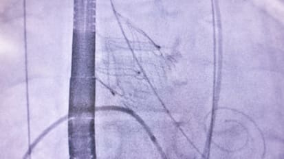 New Minimally Invasive Treatment Option for Aortic Regurgitation