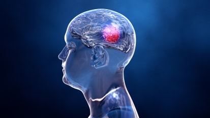 Biomarker Reveals if Benign-Appearing Meningiomas are Dangerous