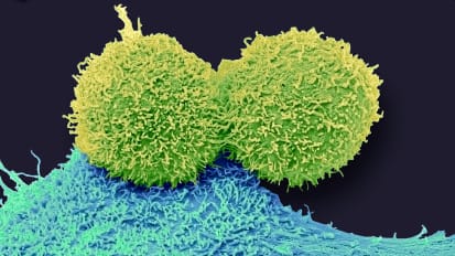 UCSF and I-SPY 2 Breast Cancer Researchers Develop Newly Redefined Breast Cancer Response Subtypes