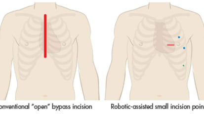 Best of both worlds: robotic-assisted bypass with angioplasty