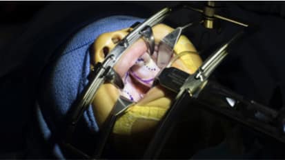 Acceptance and Speech: Surgical Repair of Cleft Palate and Cleft Lip