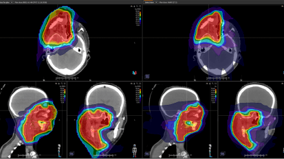 Proton Therapy Radiation Benefits Woman with Rhabdomyosarcoma, a Tumor Rarely Found in Adults