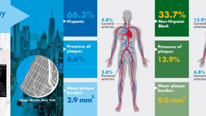 Mount Sinai Study Finds Non-Hispanic Blacks Found Twice as Likely to Have Atherosclerosis as Hispanics in Study of Young Adults in Harlem