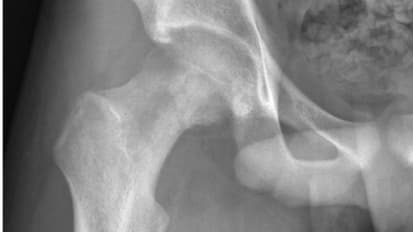 Surgical and Medical Management of Osteosarcoma