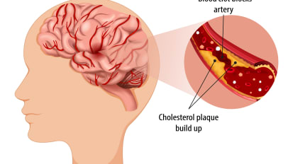 Treatment Advances for Common Cause of Ischemic Stroke