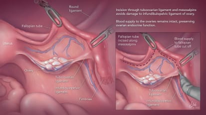 'Game-Changer’ Intervention for Ovarian Cancer Prevention