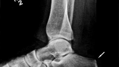 Wedge Osteotomy for Haglund’s Syndrome and Associated Achilles Tendinosis