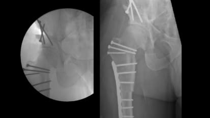 Periacetabular Osteotomy for Complex Structural Hip Deformity