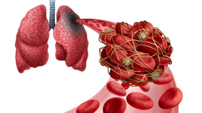Improving Clinical Outcomes for Venous Thromboembolism