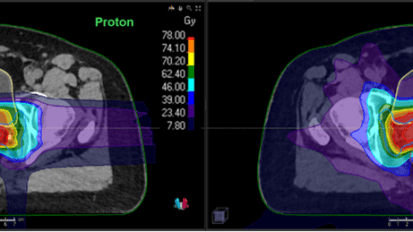 Proton Therapy Hypofractionation for Prostate Cancer</br><p style="font-size: 1.5rem; line-height: 1.75rem;">An effective option that reduces the length of radiation treatment in a young patient with early-stage prostate cancer</p>