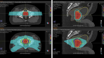 Proton Therapy FAQs for Lung Cancer