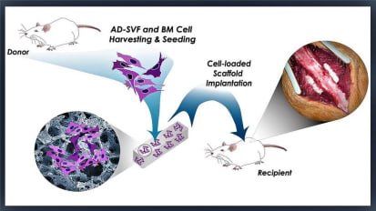 Johns Hopkins Medicine Puts Fat to Good Use as Stem Cell Source for Spinal Fusion Surgery