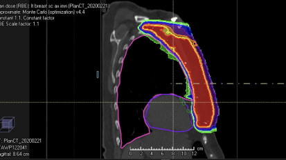 Proton Therapy Case Study — Breast Cancer