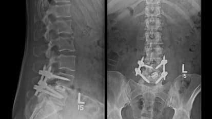 Electrical Stimulation Aids in Spinal Fusion