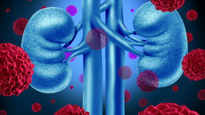 Immunotherapy Drug Delays Recurrence in Kidney Cancer Patients