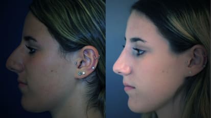 Facial Plastic Surgery Division Revives 100-Year-Old Rhinoplasty Technique With Cutting-Edge Results