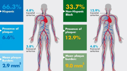 Non-Hispanic Black Adults Found Twice as Likely to Have Atherosclerosis as Hispanics in Study of Young Adults in Harlem