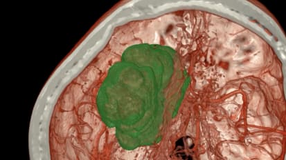 The Benefits of Preoperative Embolization for Treating Meningiomas and Other Skull Base Tumors