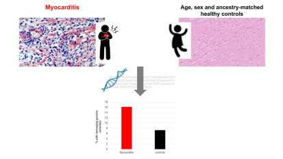 Research Links Severe Acute Myocarditis to Cardiomyopathy Genes